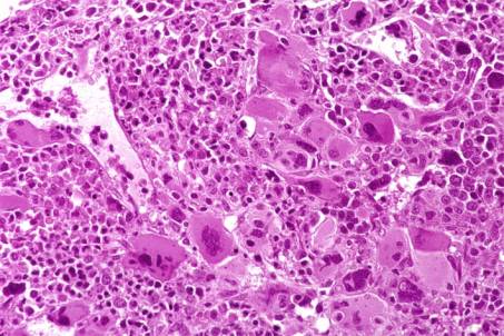 Case 7. Postpolycythemia Myeloid Metaplasia.