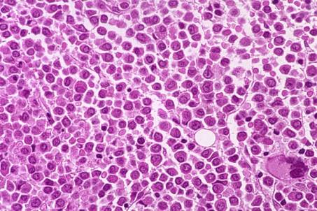 Case 10. Acute Myeloid Leukaemia M3 (FAB)